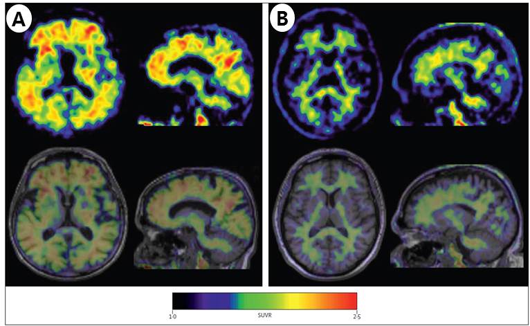 알츠하이머 치매 조기진단 PET-CT 