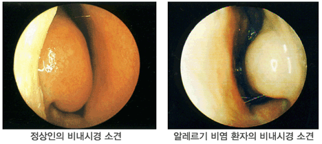 정상인의 비내시경 소견/알레르기 비염환자의 비내시경 소견
