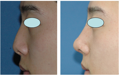 코성형클리닉 이미지